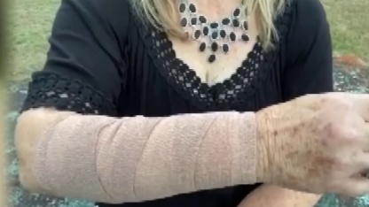Woman's Arm, all bandaged up